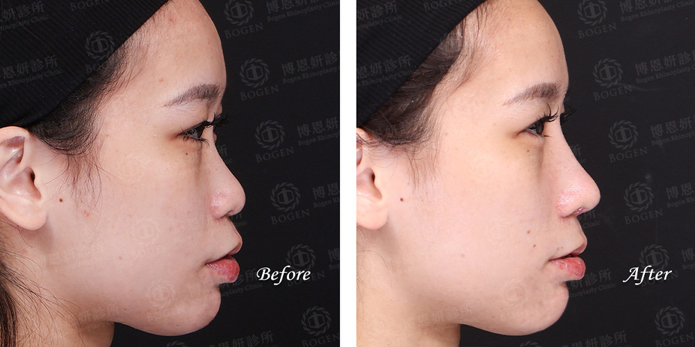 韓式隆鼻,結構式隆鼻,FITME完形美,博恩妍